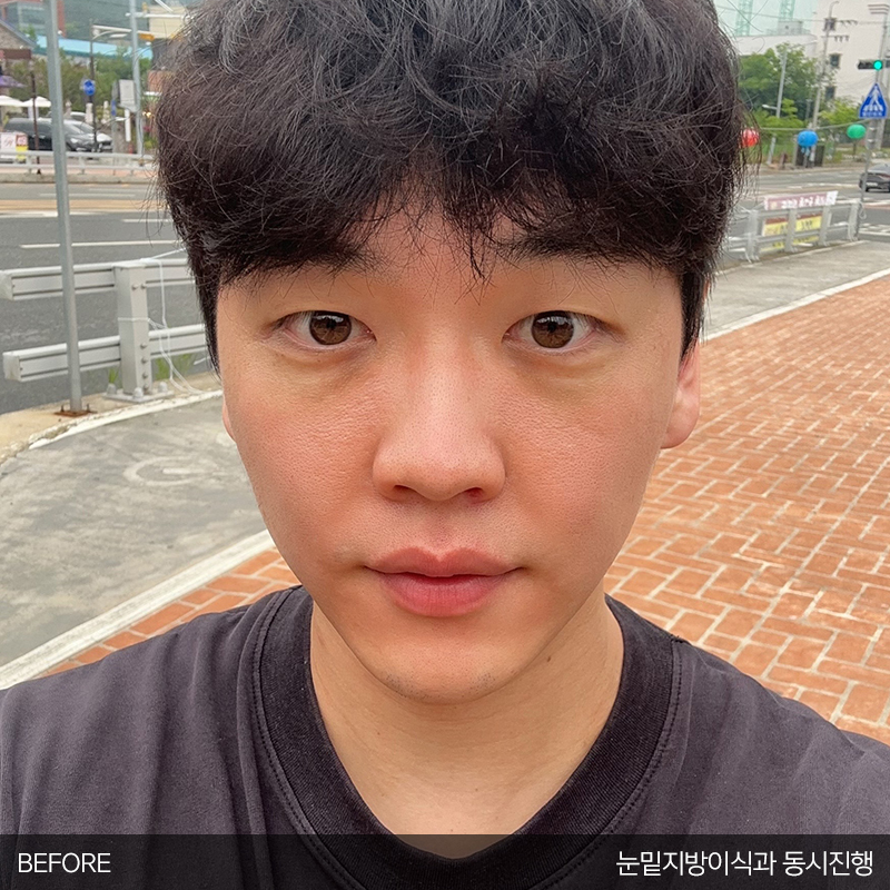 눈밑지방재배치수술효과 모르시는분! 관련 이미지 2