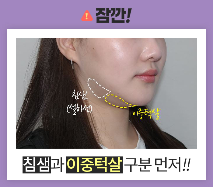 침샘보톡스전후 차이, 보이세요? 관련 이미지 4