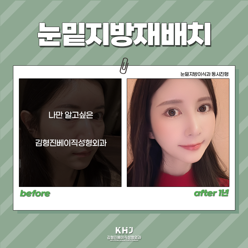 눈밑지방재배치재발? 김형진베이직에서는 걱정없어요 관련 이미지 6