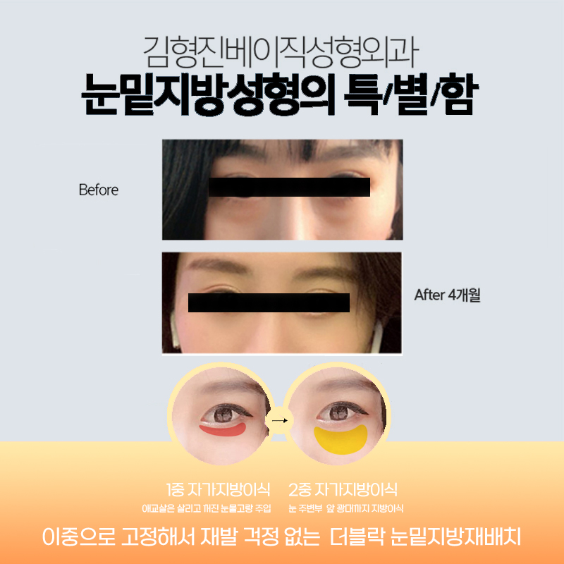 눈밑수술 병원 선택하는 기준 관련 이미지 5