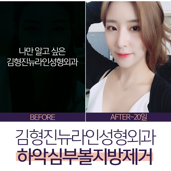 하악심부볼지방제거 볼패임을 잡다 관련 이미지 7
