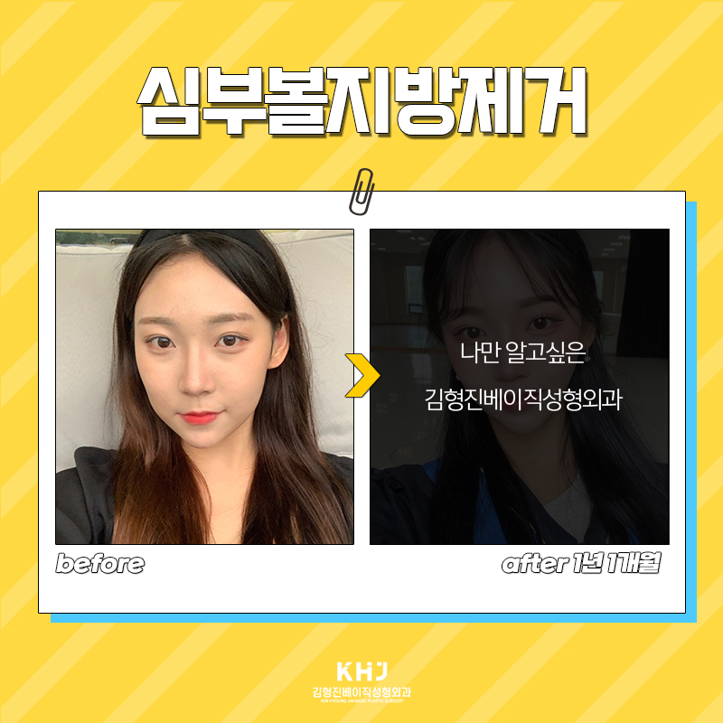 심부볼제거수술 볼패임 없이 할 수 있는 곳? 관련 이미지 6