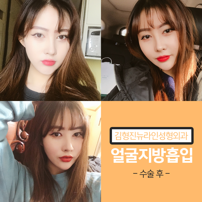 얼굴전체지방흡입 리얼후기 공개 관련 이미지 6