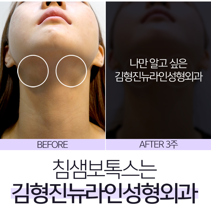 침샘보톡스 신중한 선택은 김형진원장 관련 이미지 2