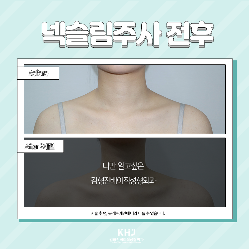 넥슬림주사시술 어디가 잘하냐면요 관련 이미지 4