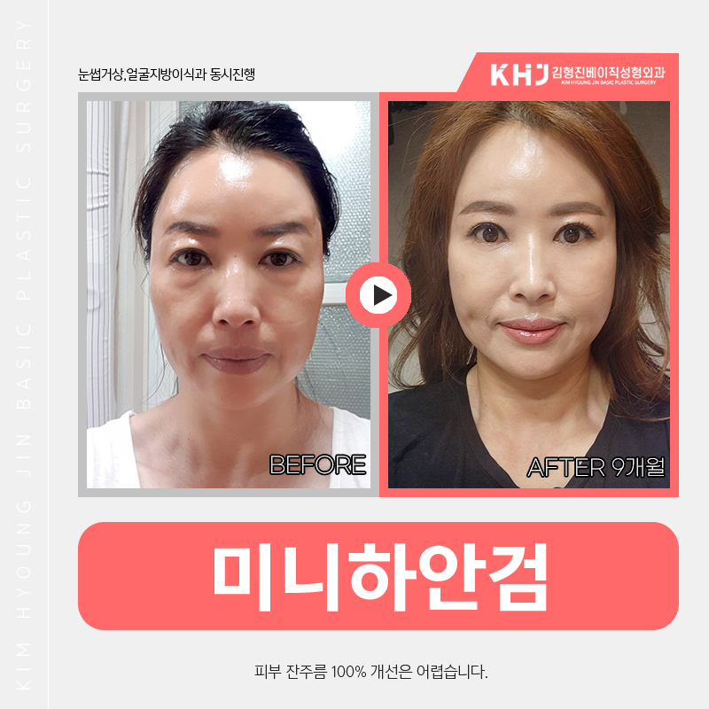 혹시 미니하안검비용 때문에 망설이고 계셨다면 관련 이미지 5