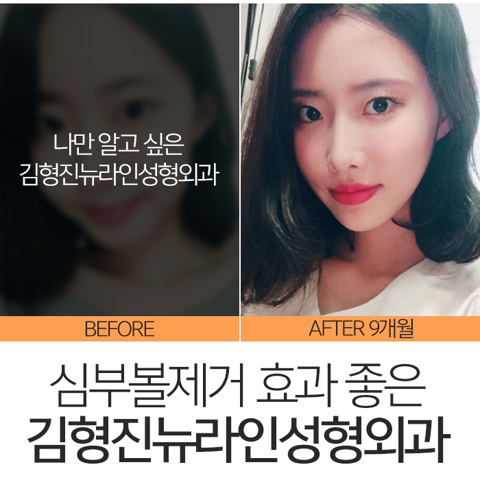 심부볼효과 확실하니까 관련 이미지 7