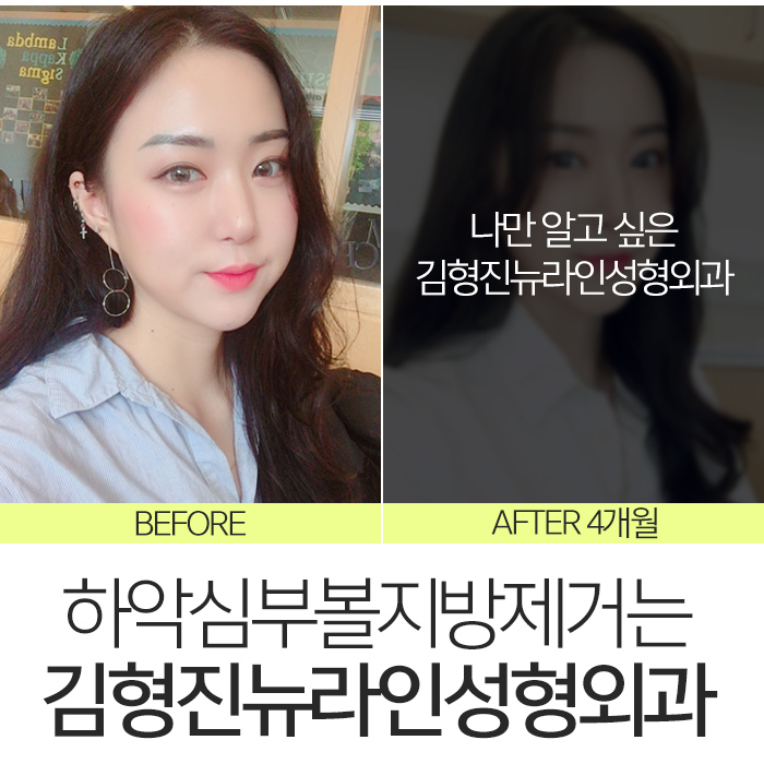하악심부볼지방제거 잘하는곳에서 해야죠 관련 이미지 3