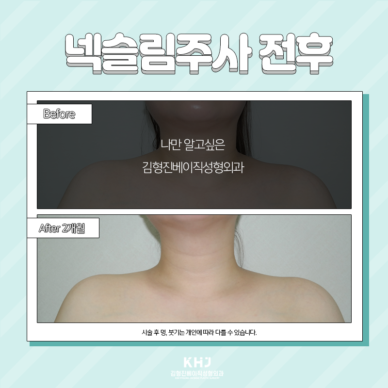 넥슬림주사효과 언제부터 볼 수 있냐면요 관련 이미지 5