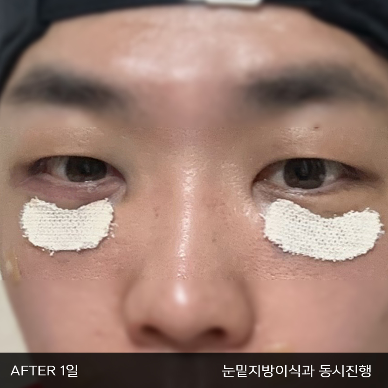 눈밑지방재배치수술이 궁금하시다면 관련 이미지 3