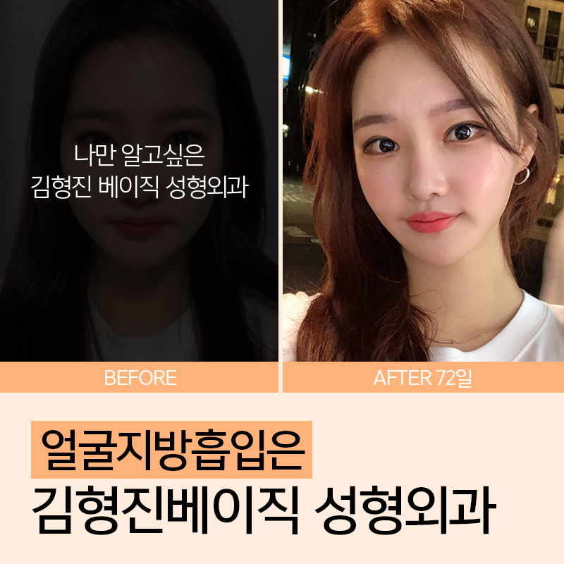 소프트브이라인! 나의 비포애프터가 궁금해 관련 이미지 7