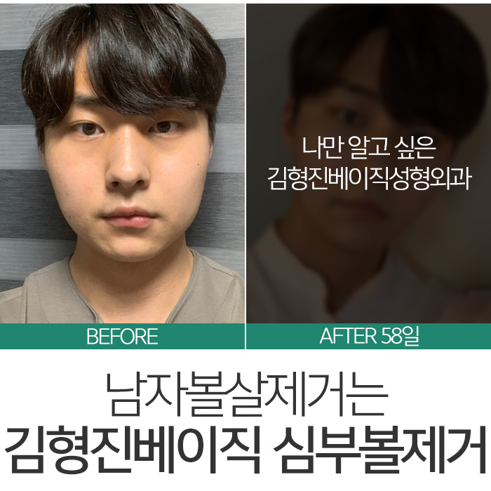 남자볼살제거 어설프게 말고 관련 이미지 8