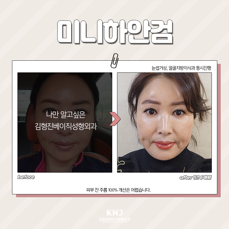 미니하안검절개 부담 갖지 않으셔도 되는 이유 관련 이미지 5