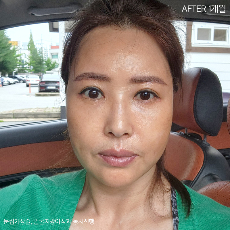 중년눈밑지방 고민은 김형진베이직에서 해결! 관련 이미지 3