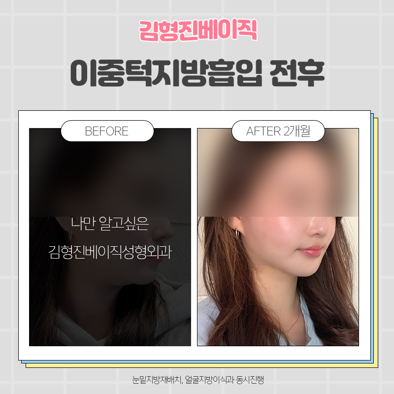 턱살흡입전후 궁금하다면 여기로! 관련 이미지 3