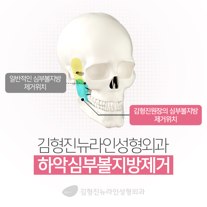 압구정심부볼제거 남다른 후기 관련 이미지 4