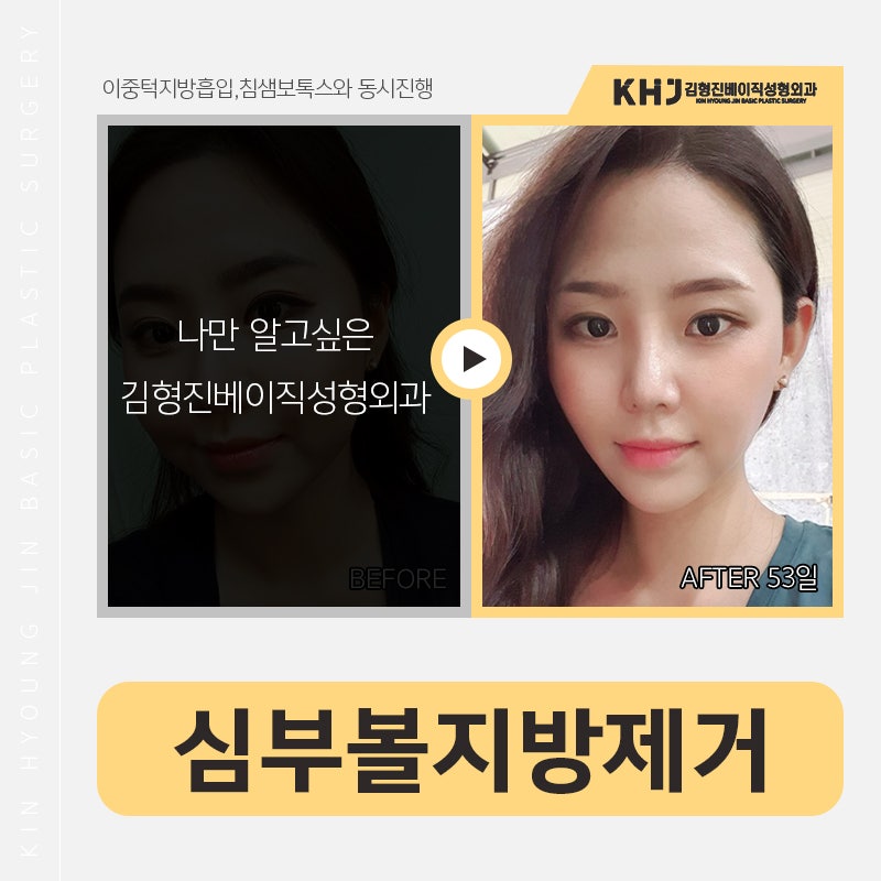 심부볼제거 부작용 걱정 왜 해요? 관련 이미지 6