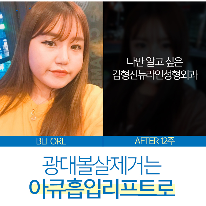 광대볼살제거 절대 어렵지 않아요 관련 이미지 2