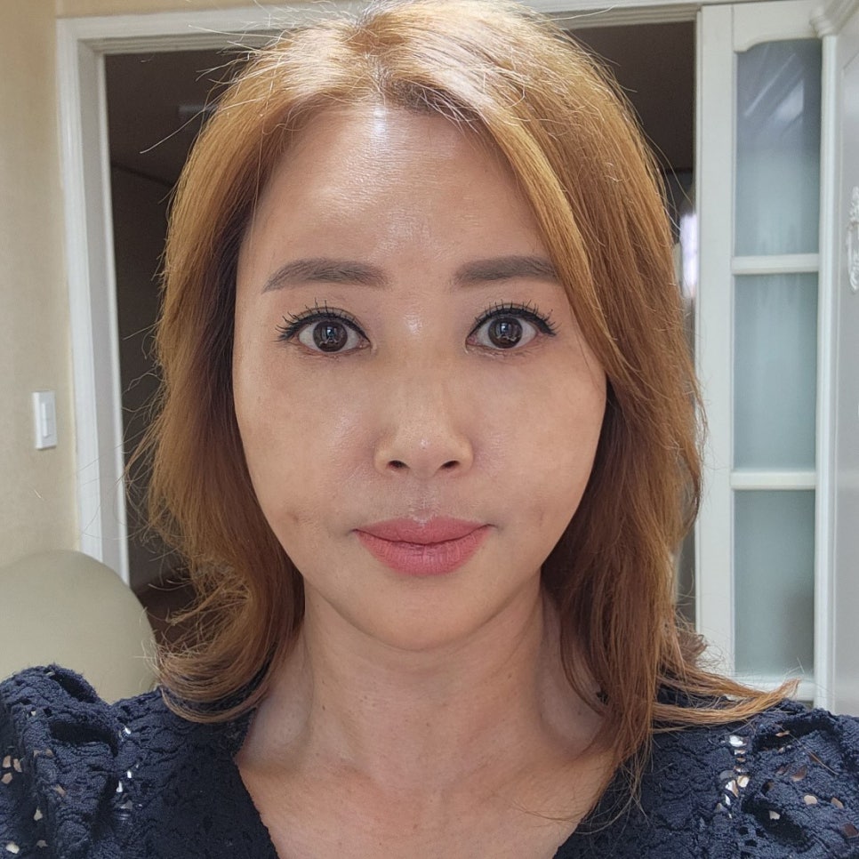 눈밑처짐수술후기 재발 없이 오래 가요 관련 이미지 2