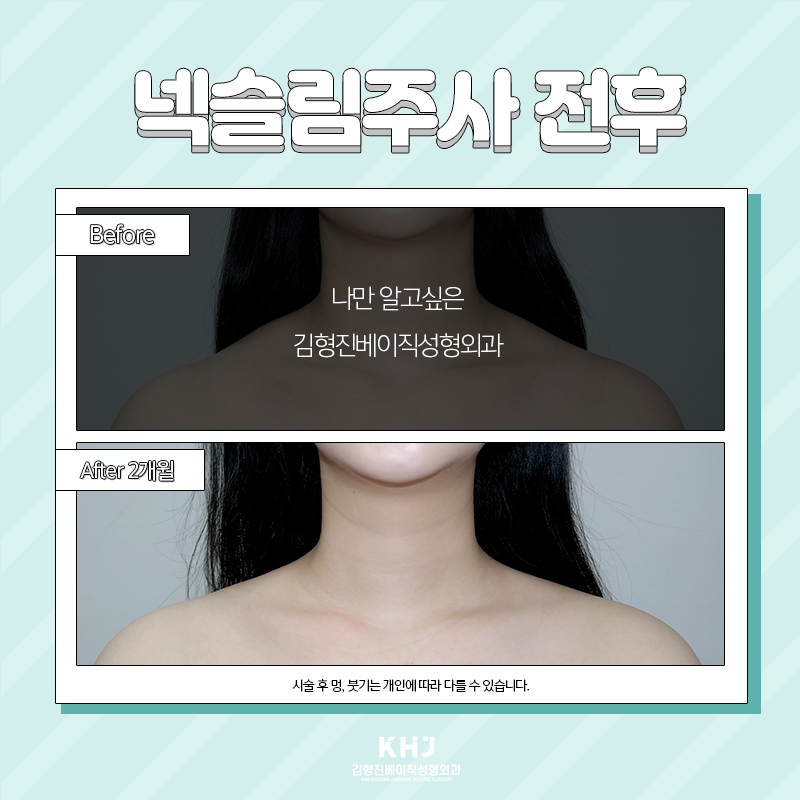 웨딩시술 뭐해야 할지 고민되셨다면? 관련 이미지 3