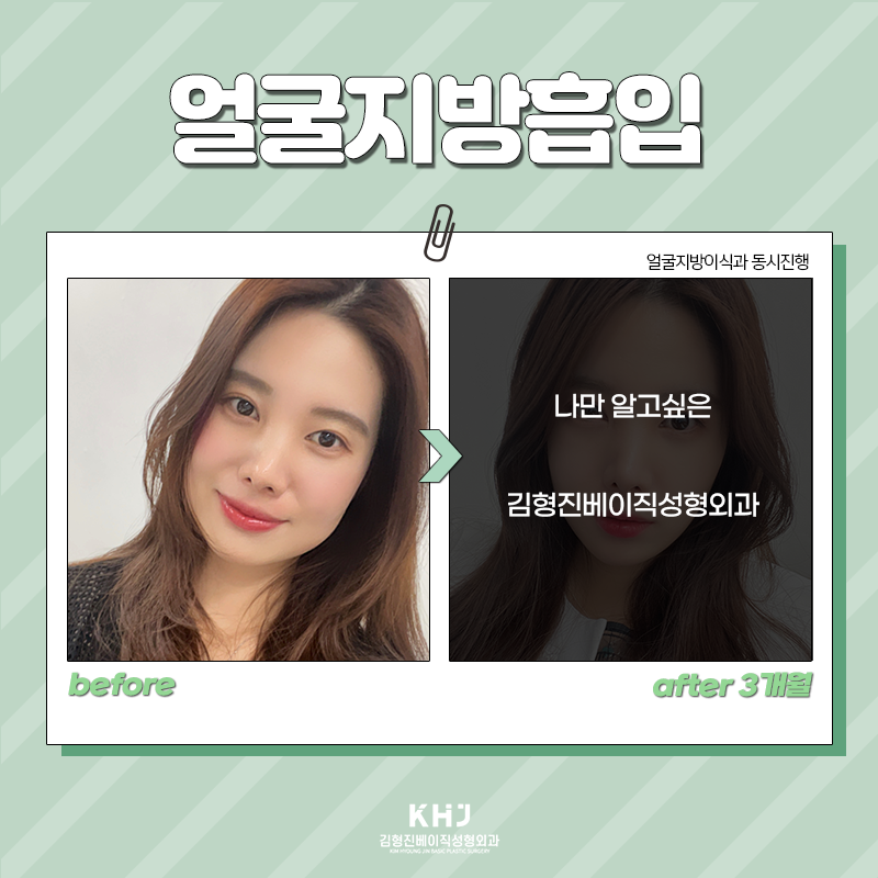 얼굴지흡효과 김형진베이직에서 알려드려요! 관련 이미지 5