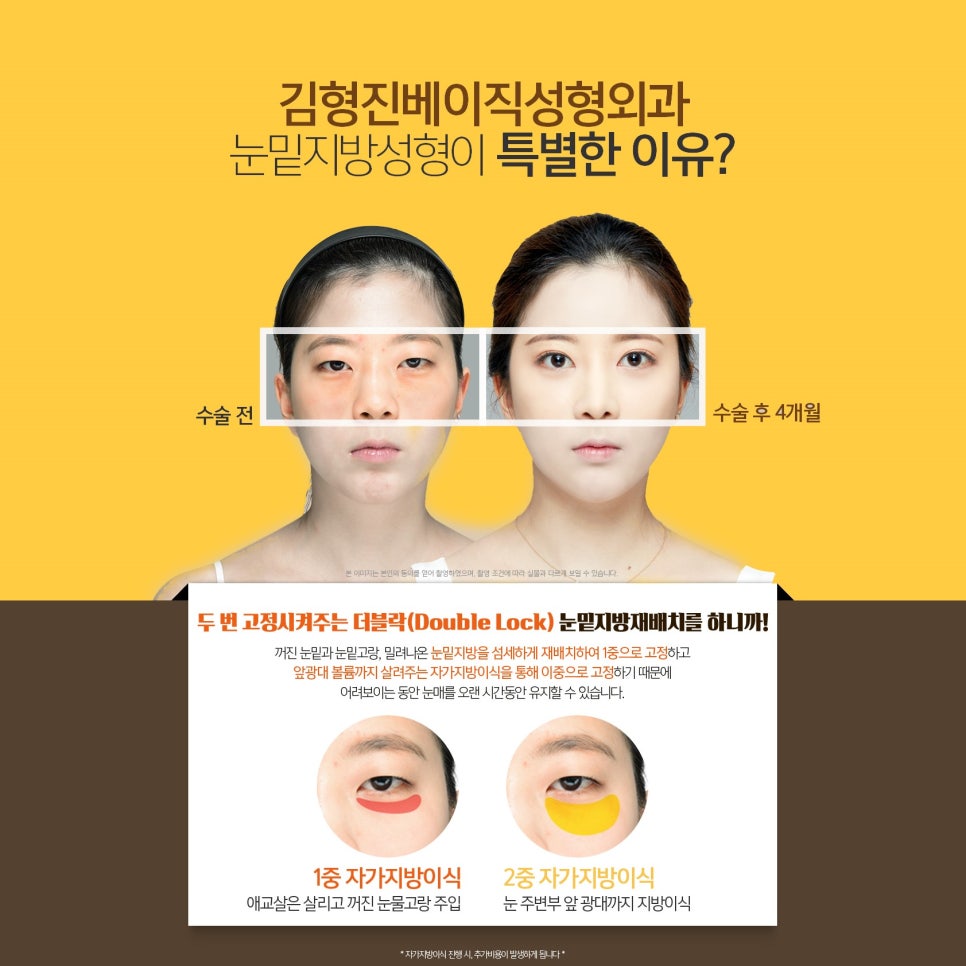 I Had Under-Eye Fat Repositioning, and Everyone Says It Turned Out Neat and Beautiful! image 4