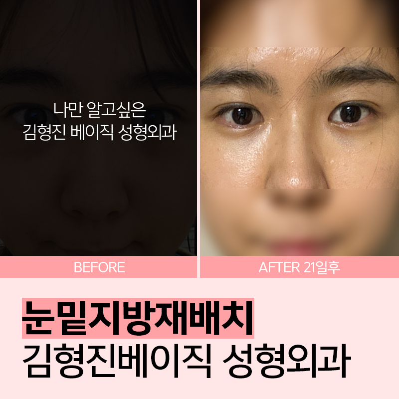 피곤해보일땐 눈밑지방재배치수술이 딱! 관련 이미지 6