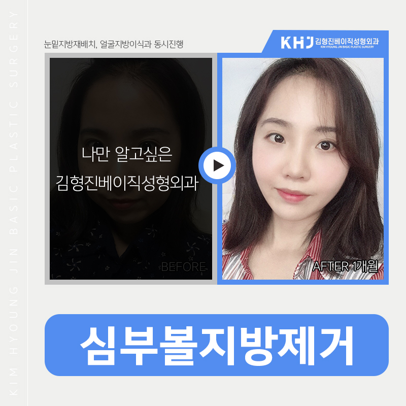 심부볼리프팅으로 해결가능하냐구요? 관련 이미지 4