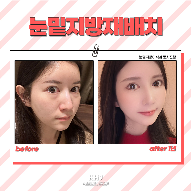 눈밑지방재배치후기가 증명하는 재발 없이 눈 밑 지방 정리 방법 관련 이미지 7