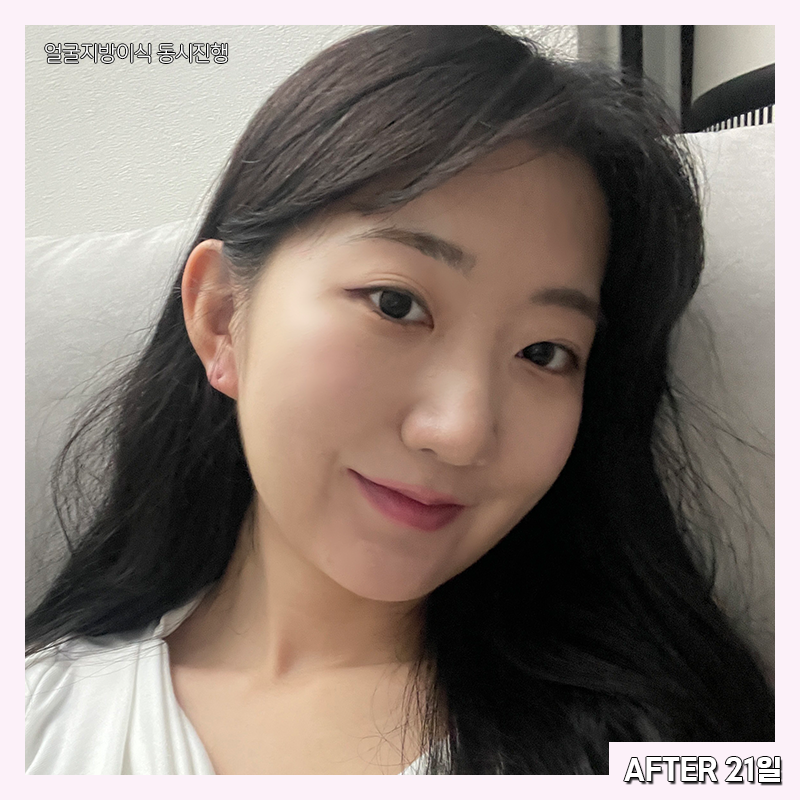 얼굴지방흡입효과 제대로 보려면 관련 이미지 5