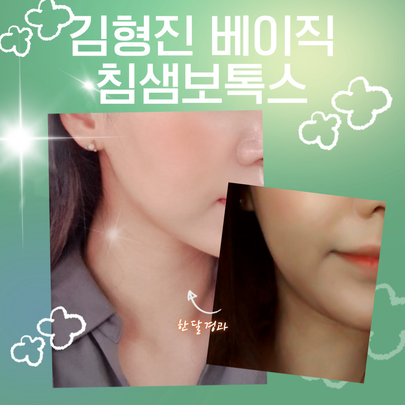 침샘보톡스효과 사각턱 아닌데 얼굴이 넓어 보인다면? 관련 이미지 6