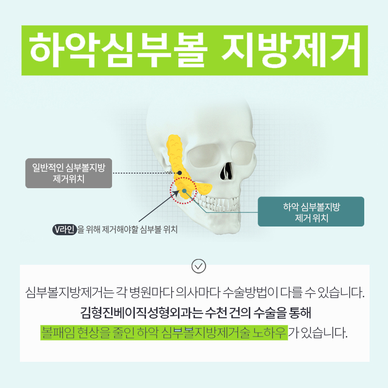 Here’s a Facial Liposuction Review~ image 4