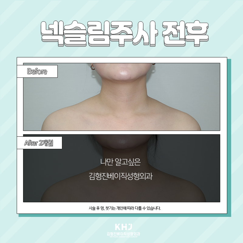 넥슬림주사전후 확인하고 가세요~! 관련 이미지 5