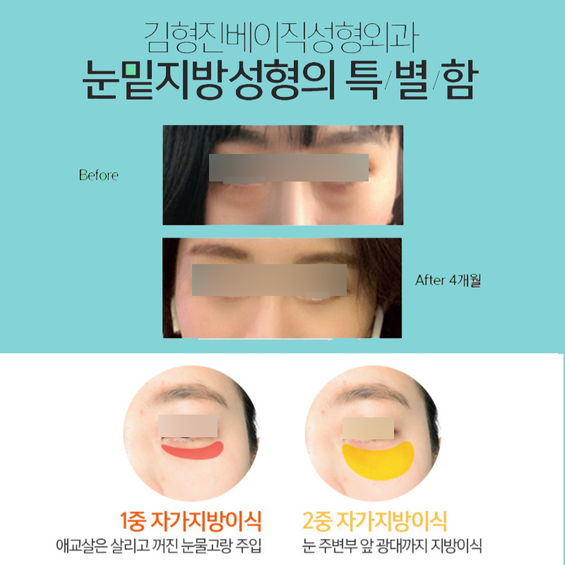 Under-Eye Fat Surgery at a Clinic Without Unnecessary Treatment! image 4