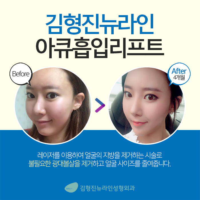 광대볼살제거 절대 어렵지 않아요 관련 이미지 3
