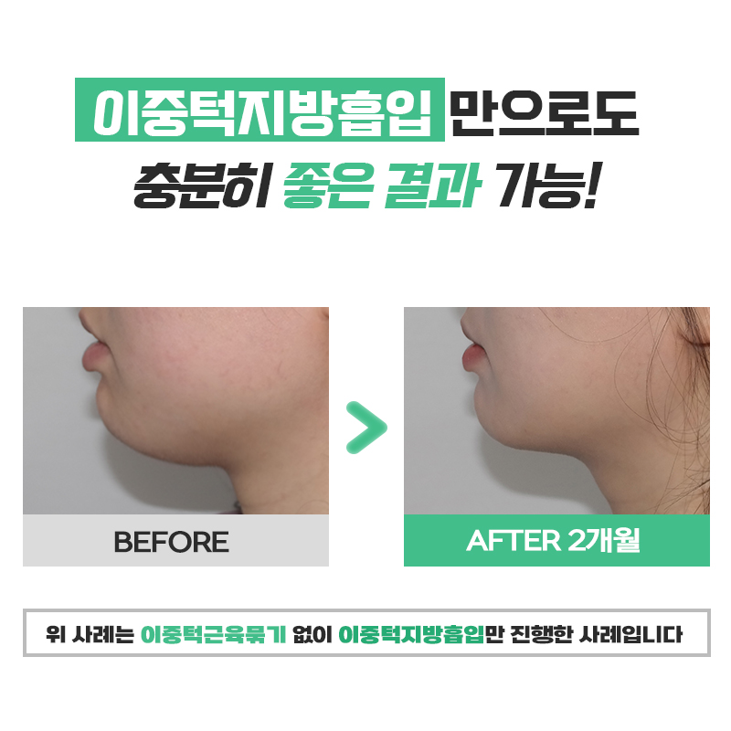 후덕한 턱살제거 고민이라면 관련 이미지 5