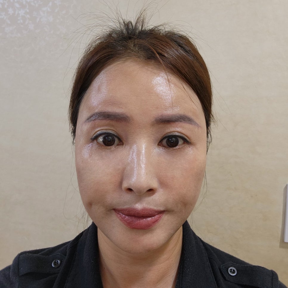 Looking for a Clinic to Reverse Sagging Without Mini Lower Blepharoplasty Scars? image 2