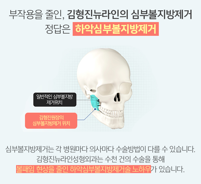 하악심부볼지방제거 어디다? 김형진뉴라인성형외과다! 관련 이미지 6