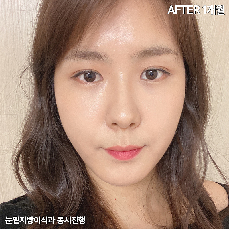 눈밑지방재배치유지력 하면 김형진베이직 관련 이미지 5