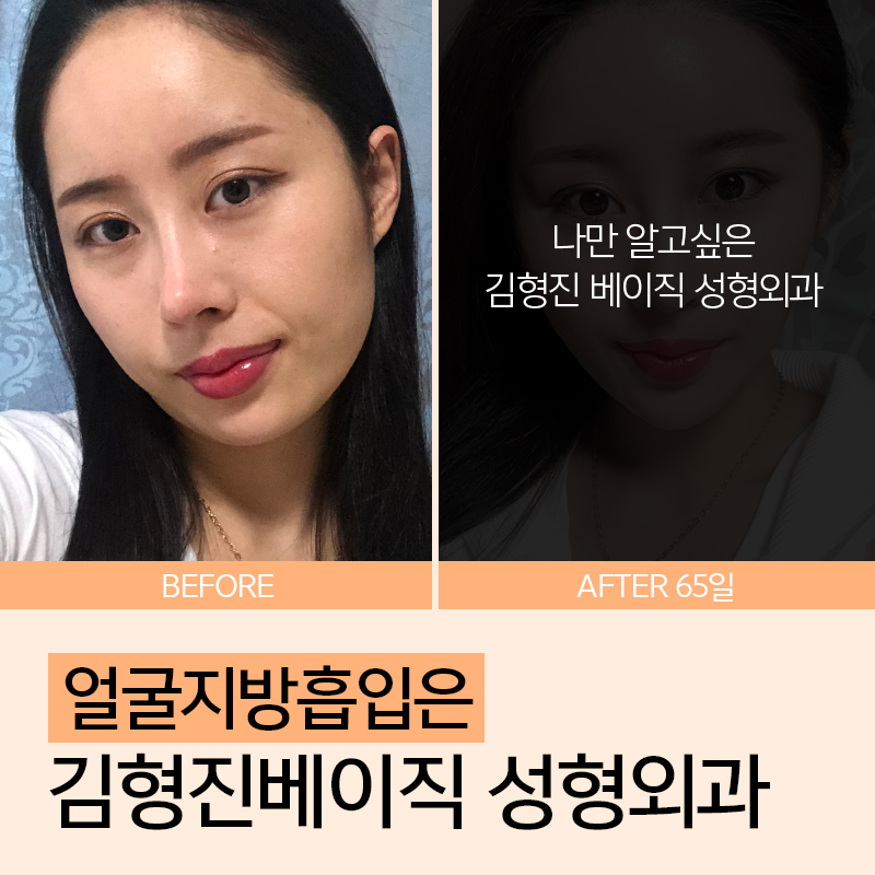 소프트브이라인! 나의 비포애프터가 궁금해 관련 이미지 3