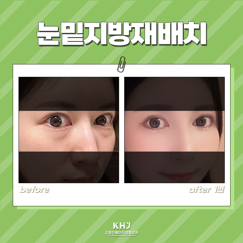 칙칙한 눈가 때문에 우울한 인상 걱정이라면? 가장 확실한 눈밑지방제거방법 관련 이미지 5