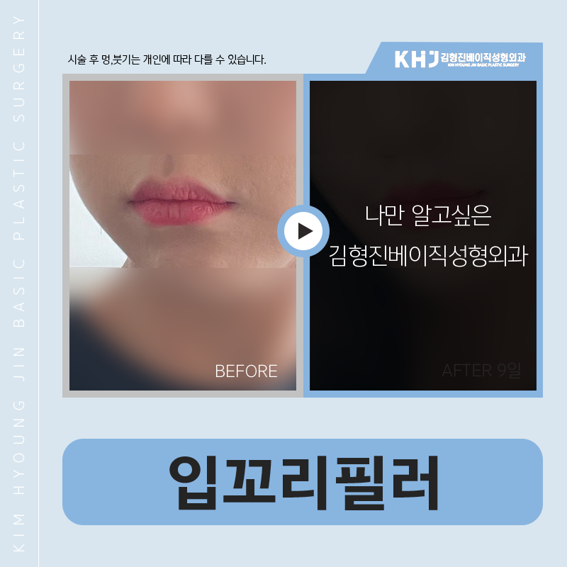 입꼬리필러모양 세심하게 잡아주는 곳 찾으신다면? 관련 이미지 5