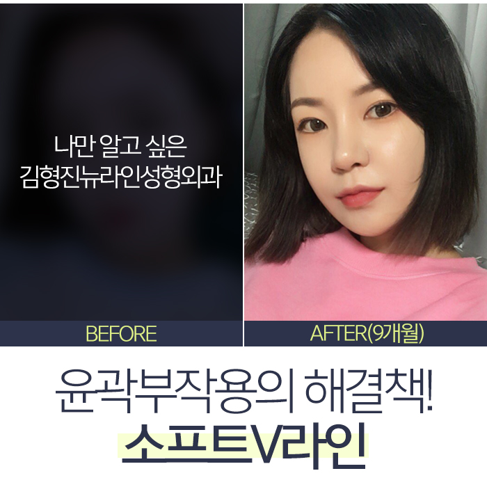 윤곽부작용 해결책 있어요 있어! 관련 이미지 7