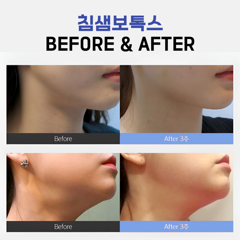 침샘비대증 때문에 고민이었다면 관련 이미지 5