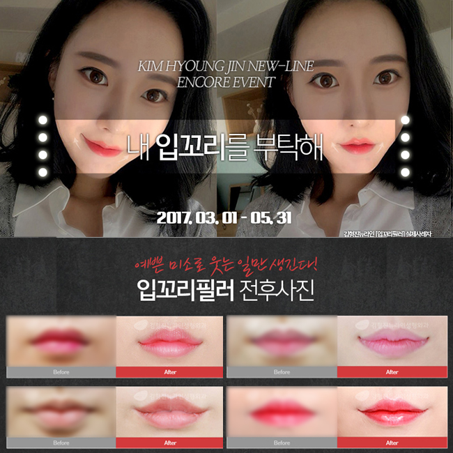 입꼬리필러가격이랑 후기 제대로 파헤치기! 관련 이미지 1