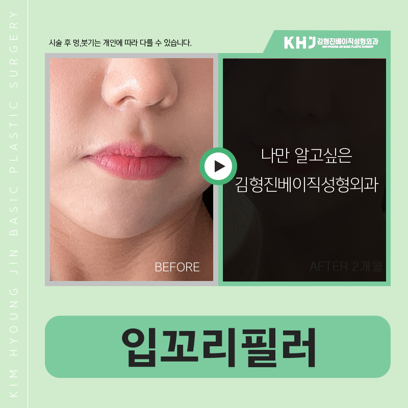 강남입꼬리시술 어디가 잘하는지 모르겠다면 관련 이미지 5