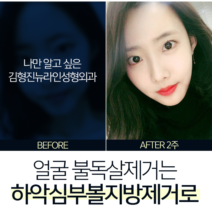 얼굴불독살 없애는방법 따로 있지 관련 이미지 7