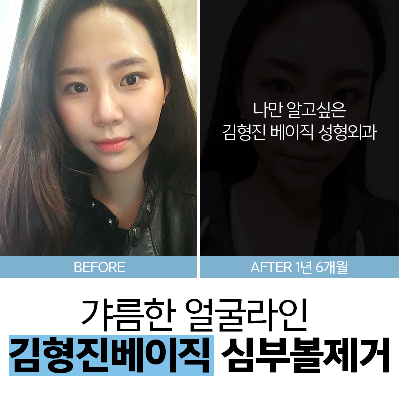 하악심부볼제거로 갸름한 얼굴라인을! 관련 이미지 6