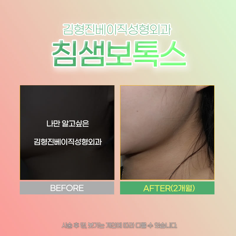 강남침샘보톡스로 부드러운 턱 선 만들고 싶다면 관련 이미지 6