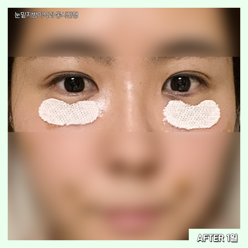 눈밑지방재배치전후 확인하고 가세요~! 관련 이미지 4